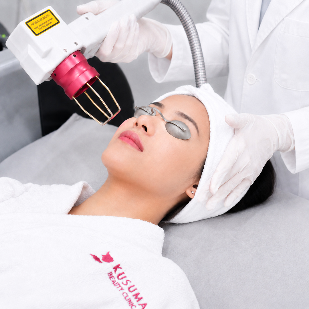 Laser Acne Cure